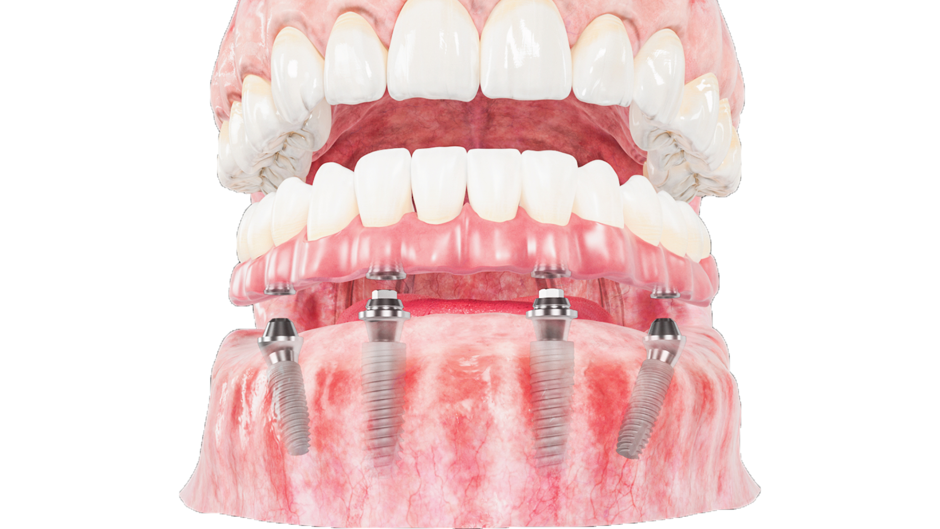 MẤT BAO LÂU ĐỂ HOÀN TẤT MỘT CASE IMPLANT