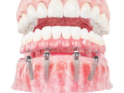 MẤT BAO LÂU ĐỂ HOÀN TẤT MỘT CASE IMPLANT