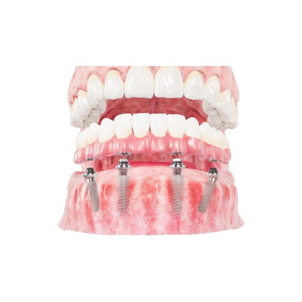 MẤT BAO LÂU ĐỂ HOÀN TẤT MỘT CASE IMPLANT